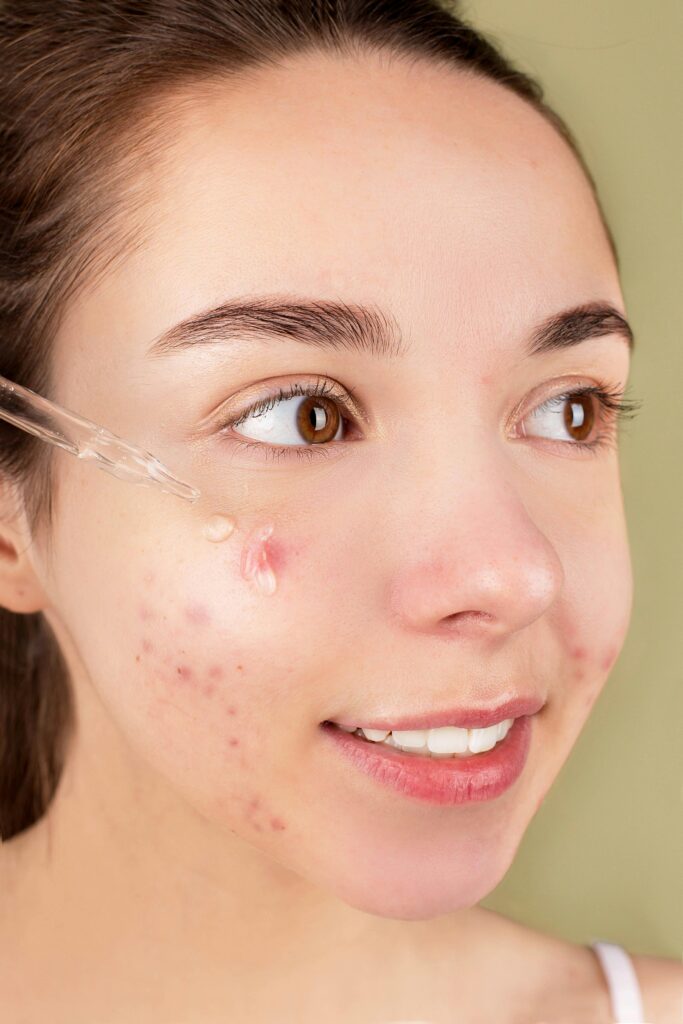 Close-up of a young woman applying serum on her face for acne treatment and skincare routine.